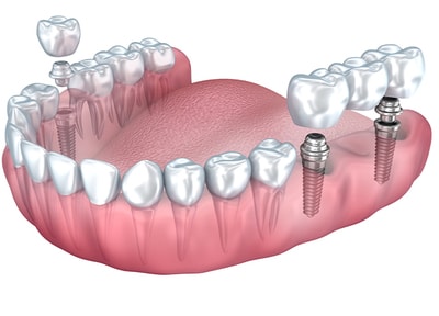 型取り・上部構造の装着