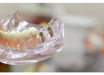 みやはら歯科医院 インプラント