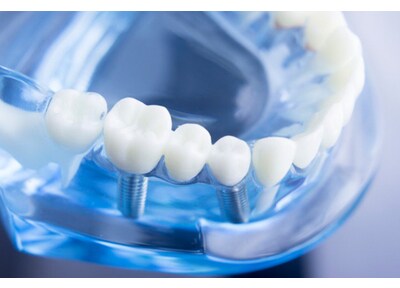 Ｋ歯科クリニック インプラント