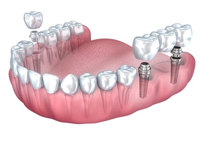 クローバーデンタルクリニック インプラント