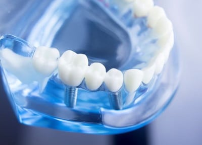 「これ以上歯を失いたくない」という方へ