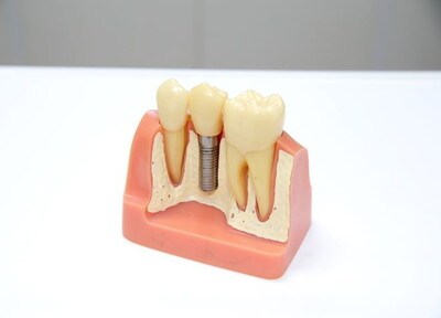 10年の保証期間付きインプラント