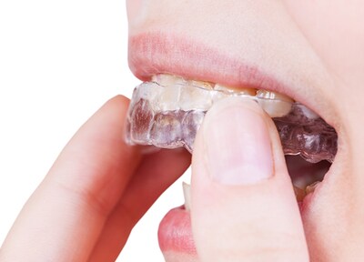 費用や治療期間、お口へのストレスを極力抑えた矯正治療