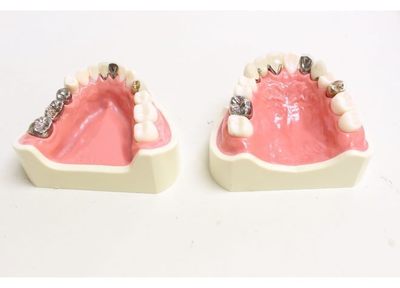 虫歯治療後のつめ物・かぶせ物では、再治療のリスクが低い素材を提供しています