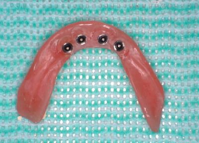 【特長６】義歯の維持装置としてのインプラント、患者様の負担軽減