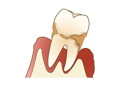 歯周病は早期治療