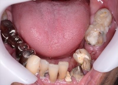 浜松デンタルクリニック 虫歯と歯周病