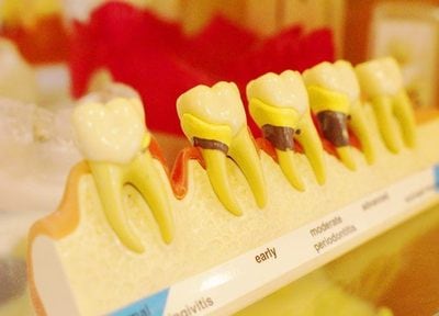 生活習慣へのアドバイスをすることで、歯周病予防を目指します