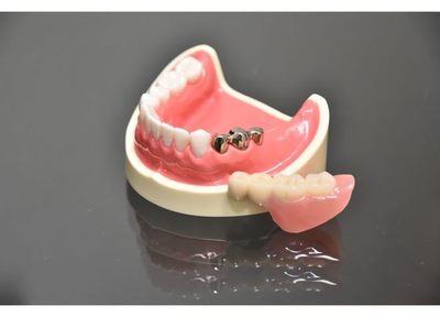 バネを使用しないため、周りの歯に負担をかけない義歯をご提供しています