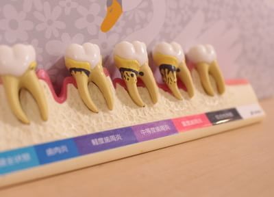 「歯周病かもしれない」という自覚を持つことで、歯を失うリスクを回避