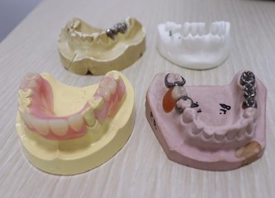 数ある種類から適した入れ歯を提案。患者さまへの負担軽減を考慮して治療を行っています