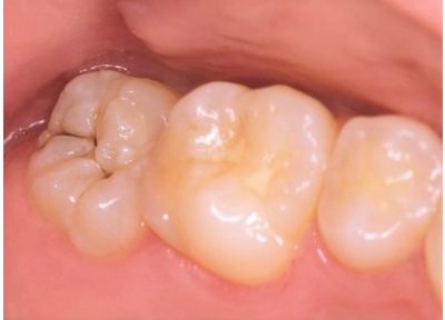 【保険診療】早期発見、早期治療！初期の虫歯なら保険診療できれいに治療できます。
