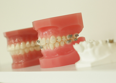 お子さまのうちから歯並びを整えることで、将来的に虫歯リスクの少ないお口になります