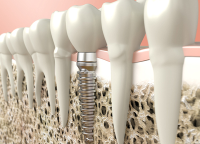 入れ歯とインプラントを組み合わせた治療も行っております