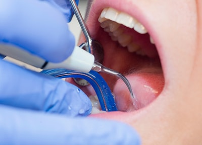 患者さまのお口の状況に合わせて、スケーリングも行います