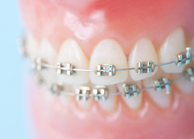 矯正歯科の特徴