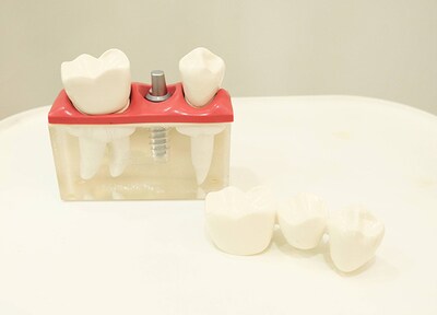 入れ歯が合わない、抜歯後も今までと同じように噛みたいといったお悩みには、インプラントがおすすめです。