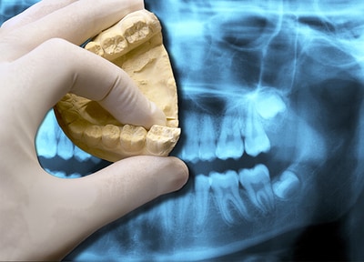 ひかわ歯科医院 親知らず