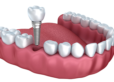 自然歯により近い、第二の永久歯と呼ばれる治療法。