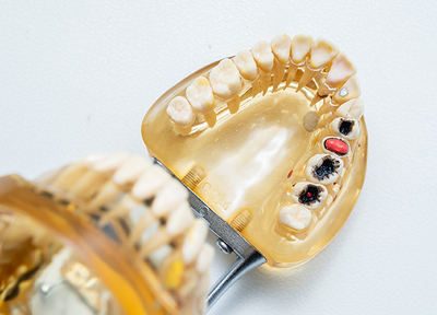 定期的に歯科衛生士によるお口のケアを受け、ご自身の歯をしっかりと守りましょう