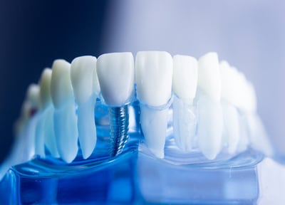 大倉歯科医院 インプラント