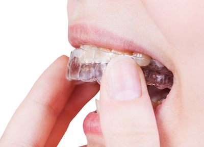 歯並びを整えることで、見た目だけでなく磨きやすさや食事のしやすさなども改善されます