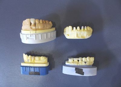 四谷歯科 根管治療