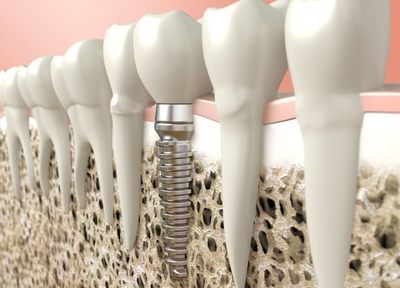 歯の移植で欠損を補う手術もできます。患者さまにより良い治療法をご提案します。