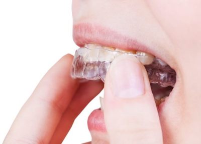 ホワイトニングを行うことで、患者さまの歯をご希望の白さまで近づけることができます。