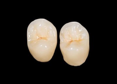 歯の被せ物には特徴の異なる三つの種類をご用意。患者さんご自身で選択可能です。