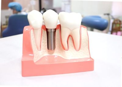 インプラントは「残った歯を大切にできる治療法」としてもおすすめです