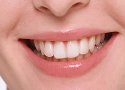 笑顔輝く白い歯に