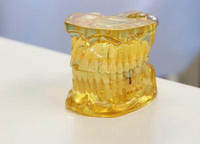 E-デンタル 虫歯