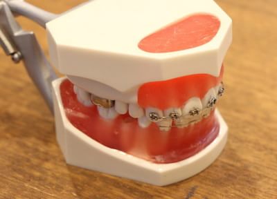 目立ちにくい矯正器具により周囲に矯正中だと気づかれないままきれいな歯並びへ