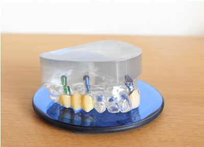 インプラント治療において大事にしていること