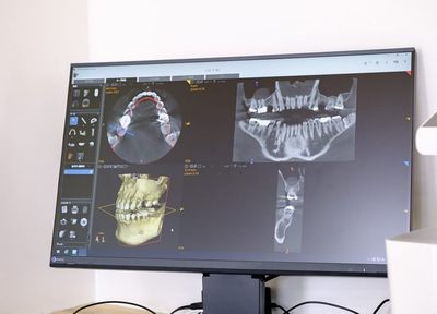 Q.インプラント治療で大切にしていることを教えてください。