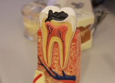 サンテラス歯科 つめ物・かぶせ物