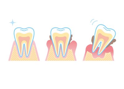 軽度な歯周病への治療法として保存療法