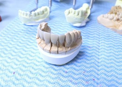 患者さまのニーズに合わせた入れ歯・義歯のご提供をしております