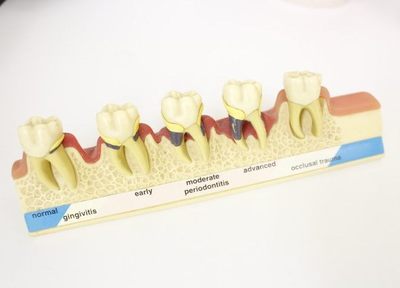 虫歯が神経に到達しないように、定期検診で症状の早期発見・早期治療に努めましょう