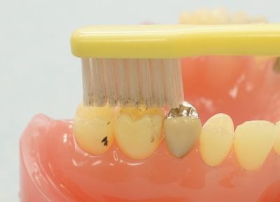 かさまつ歯科 歯周病