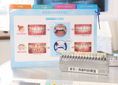 ホームホワイトニング（上下）