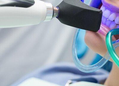 オフィスホワイトニング（上下）