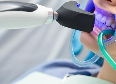 オフィスホワイトニング（上下）