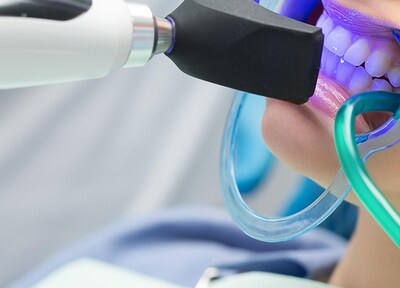 オフィスホワイトニング（片顎）