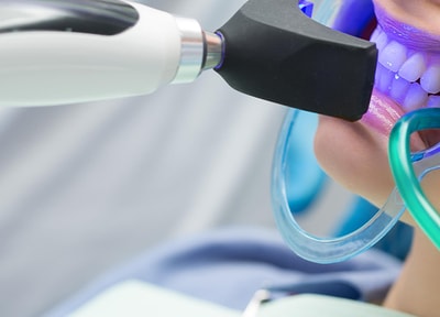 オフィスホワイトニング(片顎)