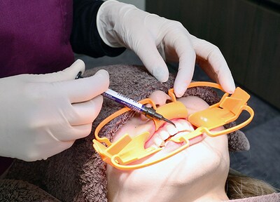 オフィスホワイトニングの施術