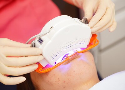 オフィスホワイトニング2回目