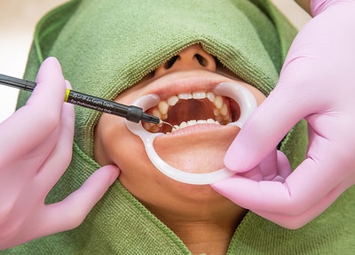 オフィスホワイトニング（上下どちらか10本）