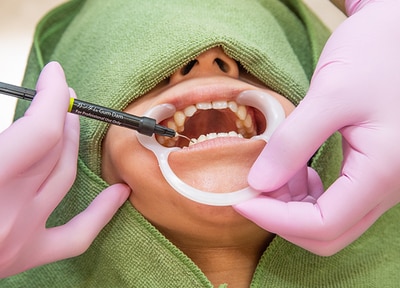 オフィスホワイトニング（上下10本ずつ）